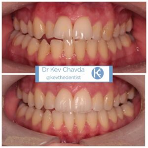 Teeth Whitening before and after 1