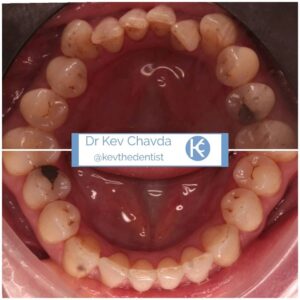 Invisalign Before and after 1