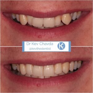 Teeth Straightening Before and After 1