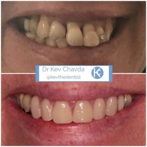 Smile Make over 1